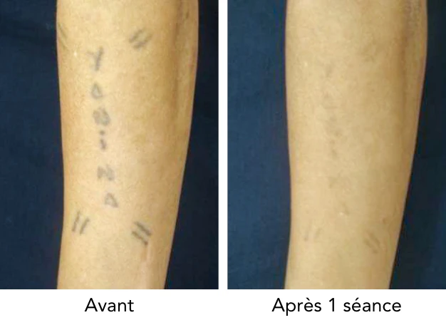 Détatouage Pico laser bras avant après