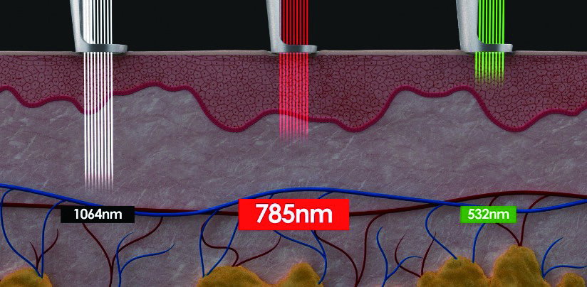 technologie Pico et nano laser